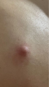 背中に貼付写真のできものができてしまったのですが これは炎症 Yahoo 知恵袋
