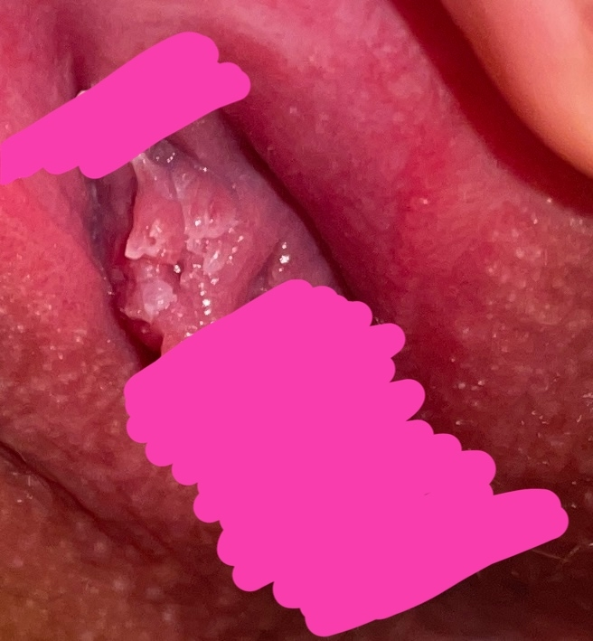 閲覧注意です 2年前にコンジローマになったことがあります 完 Yahoo 知恵袋