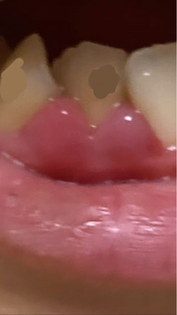 数年歯石取りに行っていなかったからか 写真のように歯茎が腫れています Yahoo 知恵袋
