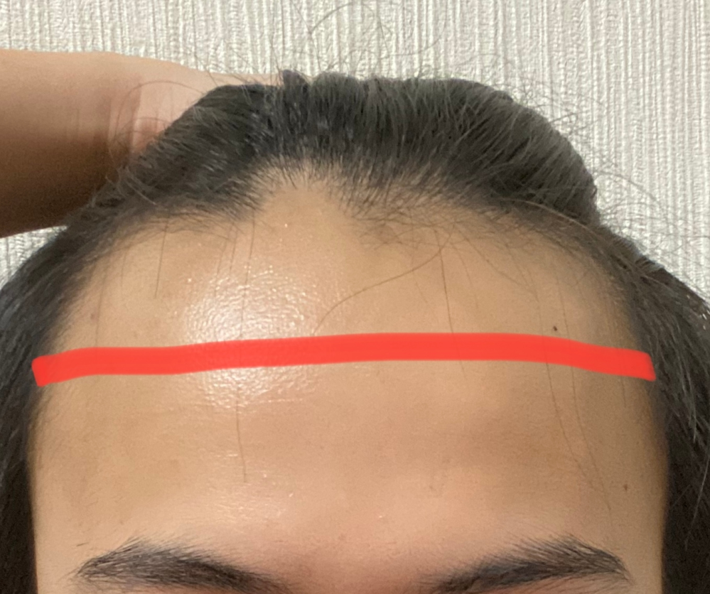 おでこが広いのがコンプレックスで植毛したいのですが 生え際から赤の線ぐ Yahoo 知恵袋