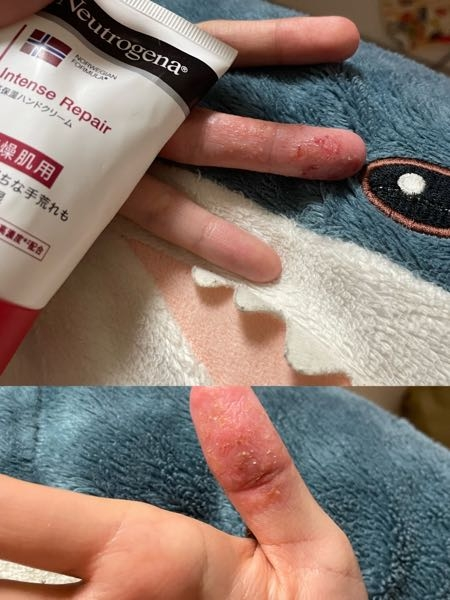 皮膚の病気 アトピー 解決済みの質問 Yahoo 知恵袋