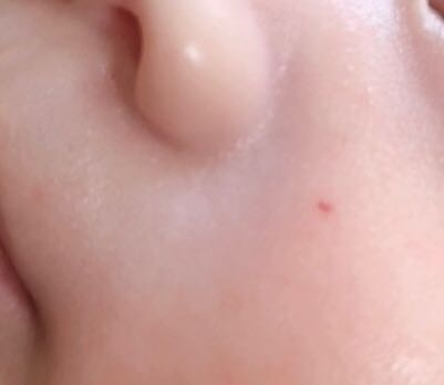 生後2ヶ月の赤ちゃんです 一昨日くらいから急に鼻の横に赤い点 が出来て Yahoo 知恵袋
