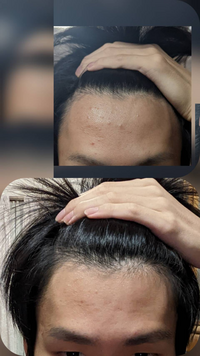 至急高一男子です 上の写真より下の写真の方が産毛が多いのですが 生え際 Yahoo 知恵袋