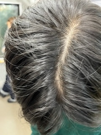 高校2年生です
最近、頭を洗っている時に髪がよく抜けます。
トリートメントなどもしているせいか髪の毛も細くなってきました。
髪の毛を分けている状態ですが、これは禿げているでしょうか？ また禿げている場合改善方法があれば教えてください！
