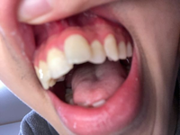 歯茎ごと前に飛び出しているんですがこれって治りますか？ 