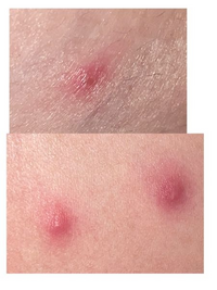 至急診てほしいです。これはダニによる被害ですか？突然できました…イエダニですかね... - 教えて！住まいの先生 - Yahoo!不動産