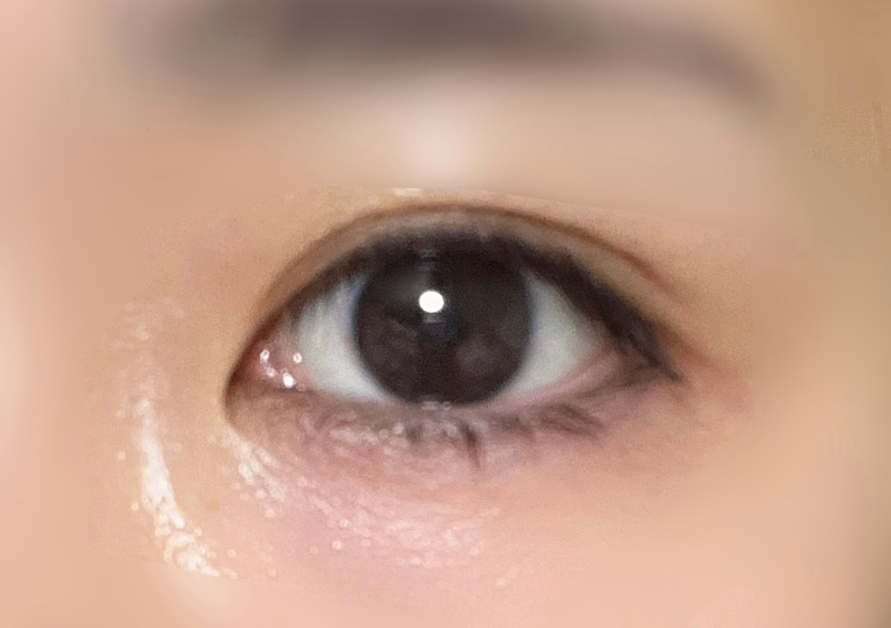 離れ目に悩んでおり目頭切開を考えていますが、切開すると涙丘が露出... - 教えて！しごとの先生｜Yahoo!しごとカタログ