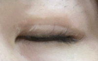 埋没をしました。


先日埋没の裏止めをしました。
有名な先生の所で、40万かけてやってもらいました。 私がやった施術だと、ほとんど腫れないと言われやったのですが、パンパンで外にも出れません。笑笑
学校行かなきゃなのに笑笑
(すみません、ちょっと愚痴ってしまいました)

本題です。
埋没後、何故か瞼の皮膚がパリパリしています。
写真だと分かりにくいかもしれないのですが……...