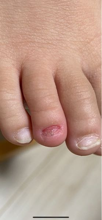 3歳児爪剥がれの対処法あさ起きたら、こどもの爪が剥がれていま