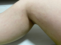 腕の付け根と太ももの付け根とふくらはぎと太ももの裏に肉割れがあり嫌です
今高校生なんですけど、不登校の時期があって外に出ずずっとダラダラしていたら急激に太ってしまい肉割れが出来てしまいました ほんとにやばいなと思いジムに通ったり保湿クリームを塗ったりしてますがなかなか薄くなりません
足を出す時はストッキングを履いてますが暑くてなるべく履きたくないです
レーザー治療以外で薄くなる方法はあ...