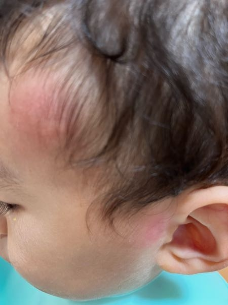 幼児ですよく舌を口から出しています、4ヶ月検診があり先生に巨舌症... - Yahoo!知恵袋