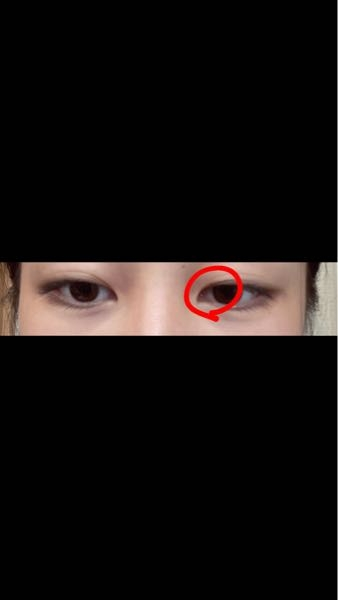 誰かお願いします。 赤丸の部分がどうしても二重になりません。多分奥二重の線が邪魔してるのかなと思います。 アイプチをしても目頭だけ食い込まず奥二重の線に肉が乗っかって変な目になってしまいます。 瞼が伸びているのもあるかと思います。 整形以外で解決する方法はありませんか？