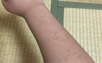 中学生女子です。
このぶつぶつどうしたら無くせますか？？
小さい頃からずっとこの腕が大っ嫌いでした。 小学生の頃、体育の時間では半袖半ズボンだったため、とっても最悪な気分でなるべくみんなに見られないようにと、腕を組んだり腕を後ろにしたりと
めちゃくちゃ最悪でした。
夏になってもこの腕で外出したくないので、暑くてもなるべく長袖を着ていました。
中学生になったら学校のジャージを着れるようになりま...