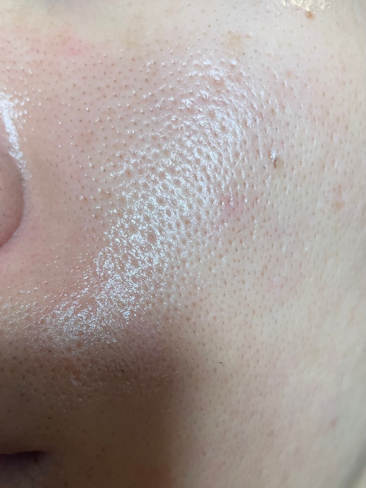 37歳男です。 もう諦めてますが、この毛穴はたるみ毛穴ですよね？ 朝はビタミンc系、夜はレチノール、ナイアシンアミドを使ってますがやっぱ良くなりません？ もしおすすめあれば教えて頂きたいです。 お手上げです笑 因みにダーマペン10回やってこのクオリティーです