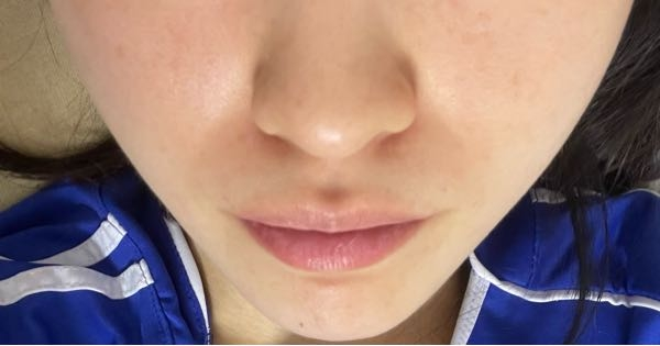 22歳学生なんですが最近めちゃくちゃほうれい線が気になっています。特に画像左側が濃いんです… これどうしたら改善するでしょうか？ 頬の肉がありすぎるとほうれい線ができやすいと聞きますが、細身体型でそこまで頬肉はついてないと思います…