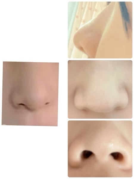 鼻整形を考えています。理想は左のような鼻です。小鼻縮小、鼻栓形成、軟骨移植、鼻中隔延長でなれますか？肉厚な鼻なので、小鼻縮小はやめた方がいいですか？