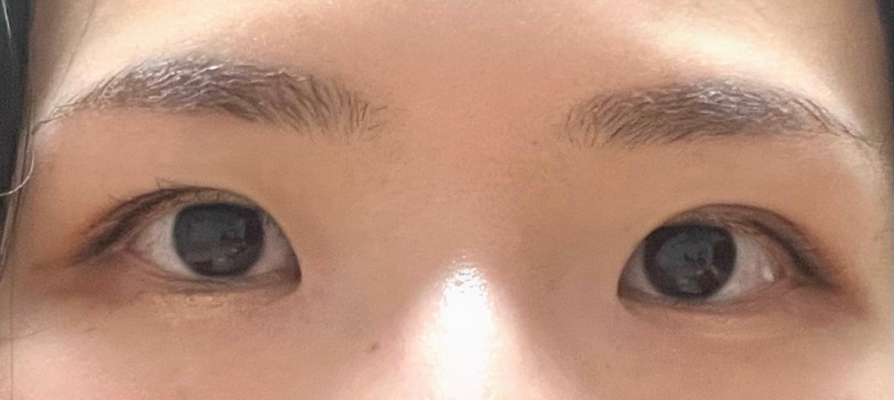目頭切開するかどうか悩んでいます。女です。 眠たげな目がコンプレックスです。 SNSで目頭切開レポなどを見ると、「やらない方が良かった」というコメントもよく見かけるので切開して後悔するのが怖くて悩んでいます。もう少し意思が強くなればカウンセリングに行く予定です。 この目元は目頭切開でかわいくなると思いますか？
