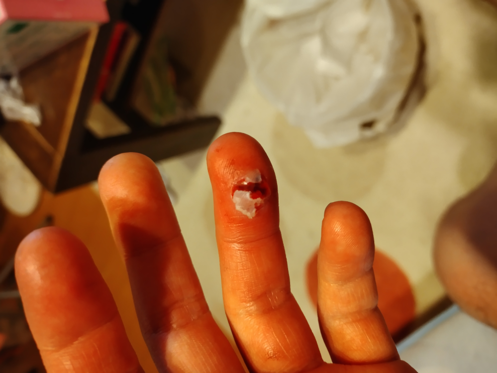 猫に噛まれました。 指の状況なのですが、病院にすぐいったほうがいいですか？ 病院には全て断られました 家で取ったのが最新で、あっかしてますでしょうか？