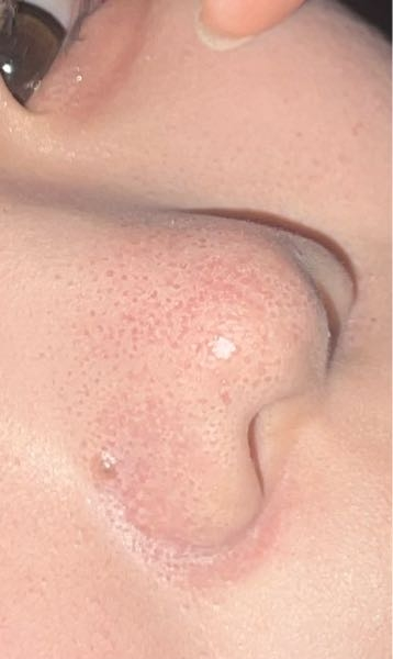 メイクをしてマスクを5秒しただけでもこうなります。 鼻の上が赤くなってしまう＆毛穴があるのがコンプレックスで鼻の赤みはコンシーラーで隠そうとするのですが結果この写真のようになっちゃいます。助けてください（；_；）
