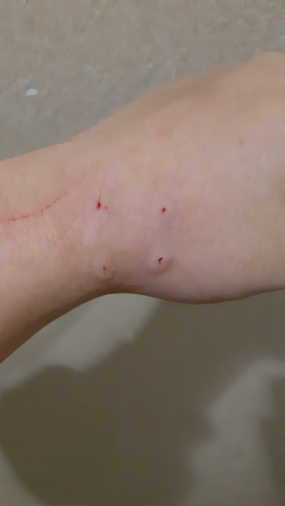 飼い猫に噛まれてしまいました。 一応エタノール消毒はしたのですが、病院にいった方が良いのでしょうか？ それとも放置で平気ですか…？