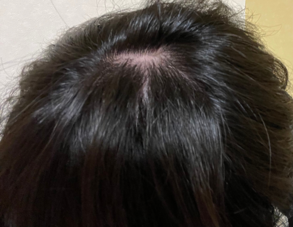 高二です。これって禿げてますか？