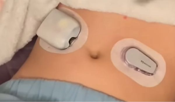 海外の人の動画で子供の体につける針がついてるもの？みたいなのを付けているんですけど、なんですか？
