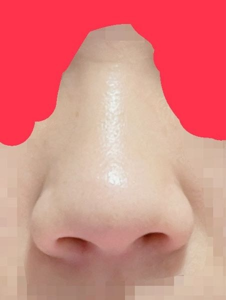 この鼻は何鼻ですか？ 一般的にはブサイクの部類になる鼻だと思っているので、いずれ整形したいのですが違和感が無くモテ鼻？にするにはいくらぐらいかかるでしょうか？ ちなみに鼻の横のほうれい線みたいのも整形じゃないと消えないのでしょうか？ 自分はアレルギー体質でよく鼻をかんだり、鼻の中が傷つくことが多いのですが そういう体質の人は鼻整形はむいてませんか？ 沢山の意見を知りたいです。 よろしくお願いします。