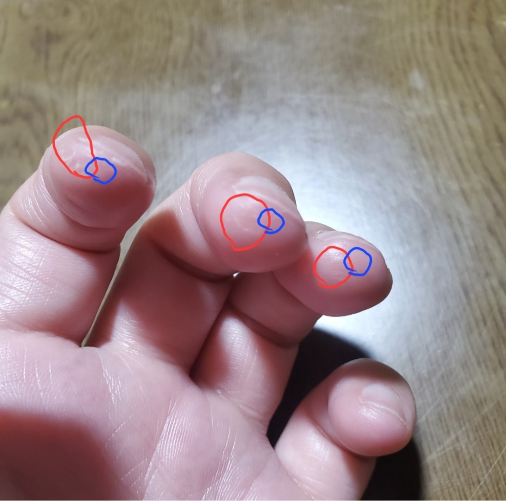 ギター初心者の指に出来るタコの位置について質問です。 アコギを始めたのですが、Cコードが押さえられず何度も練習していたら写真の赤丸の場所の皮膚が厚くなってきました。 特に人差し指は親指側の爪側面で弦を押さえないと中指薬指で押さえるべき弦まで届きません。 よって、より人差し指はささくれができるあたりまで斜め楕円形に皮膚が固くなっています。 もっと真ん中(青丸)に出来ていないと、正しく押さえられていないのだと思いますが、どう改善すれば良いでしょうか？ 人差し指を立てればいいのでしょうが、そうすると薬指がフレットからかなり遠い場所でしか押さえることが出来なくなります。 また、親指ミュートしようとすると、１弦２弦が鳴らなくなり、より人差し指は指の側面よりで押さえるような形になってしまいます。 女性で手が小さいと仕方ないのか、またミュートまでやる必要がないのかも含めてご回答お願いします。 アルペジオではなくコード弾きなので、いつまで経っても綺麗な音が鳴らずどこを改善すればよいのかお知恵を頂ければと思います。