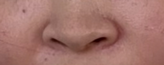 この鼻は何鼻ですか。 小鼻を小さくしたいのですが、マッサージで小さくなりますか。 また、整形する場合何の施術がいいですか。 理想は大谷映美里ちゃんのような鼻です。