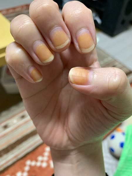 マネキュアを塗って 除光液で消したら 爪がオレンジ色になってしまいました どうすれば元の爪になりますか？