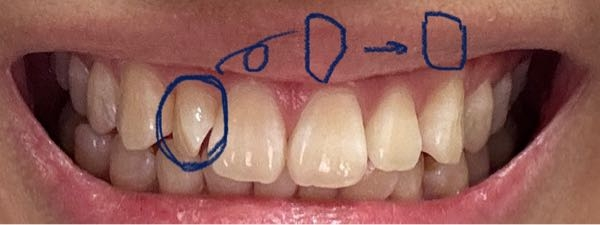 歯列矯正について。 ここの歯の角度を変えることはできますか？ 現在歯の横側が正面に来ていますが、 平らになっている部分を前に持っていきたいです。 わかりにくいですが、青いペンのような感じです。