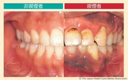 喫煙すると歯茎の色が変わりますか？