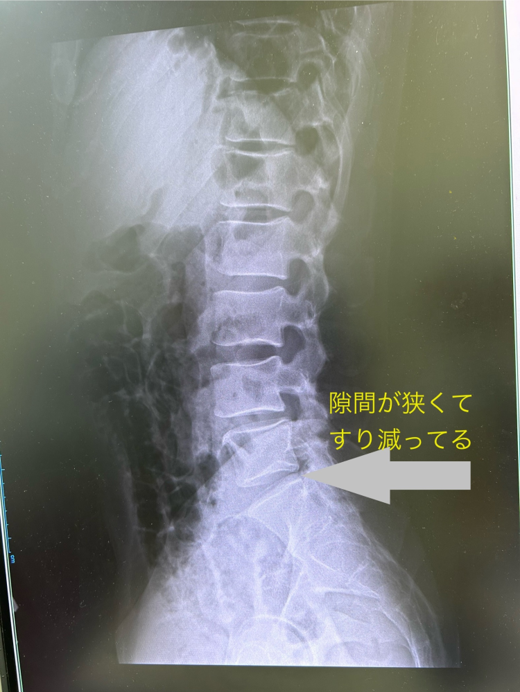 40代で陸上競技を長年続けて来ていますが、30代前半からふくらはぎの痛みが度々出て、ツラい陸上人生を歩んでいます。 元々は100m選手でしたが、ふくらはぎをよく痛めるので、今は長距離の練習をしてリハビリ？しています。 痛みは、走ってると急に痛くなります。足の着地、反発を得る動作のみ痛くなり、痛くなると3週間くらいいつも走れなくなります。歩いたり、カーフレイズ筋トレ等は全く痛くありません。 走るという動作のみです。 ジョギングをしてて15分くらい経つと痛みがでたりとか、痛みが出てる時は走りはじめれば5分以内に痛くなります。 痛みが出ない時は1時間や、ハーフマラソン走り切る事もできます。年間3〜5回痛めます。痛みが出なければしばらくでず、痛みが出るとしばらく続いたり連続で痛みが出やすいです。 カイロプラクティスの先生は、坐骨神経や骨盤、腰が悪く、神経の痛みだと言われています。肉離れとか筋肉の痛みでは無いと言われます。 接骨医院等では、痛そうな足では無いとよく言われます。筋肉が硬くなったりしてないからですね。 腰は痛くなりにくいです。腰の痛みがでないのが不思議なくらいとカイロの先生には言われていました。 しかし、先日、初めて腰を怪我しました。画像の通り、椎間板ヘルニア系の怪我だと思います。 ふくらはぎは、腰から来てるものなのでしょうか？ 原因を究明して、治したいです。 MRIとかも一度撮った方がいいのでしょうか？ しかし、整形外科行っても大きな病院じゃないと機械ないと思いますし、レントゲン撮って以上無しで終わりそうとか、整形外科に相談するのも億劫です。 私みたいな経験者の人がいたら嬉しいのですが！