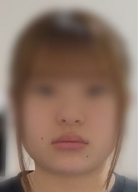 口角にほくろのある彼女 ブラック M ホクロ - 東京 渋谷 美容皮膚科 マグノリア皮膚科クリニック