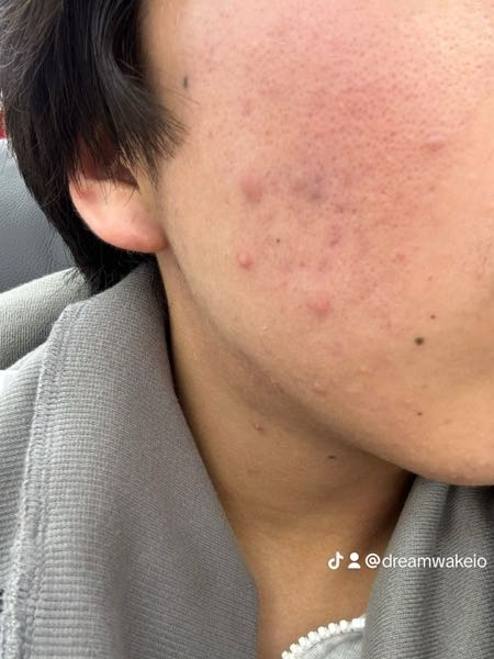こんな感じの肌で生活習慣とかお菓子とか水など出来ることは全てしてるのですがここら辺の肌感から良くなりません。本気で綺麗にしたく悩んでます。 なので美容治療に頼ろうと思うのですが、ダーマペンがいいのかとかよく分かっていません。 この肌には何をするべきですか？