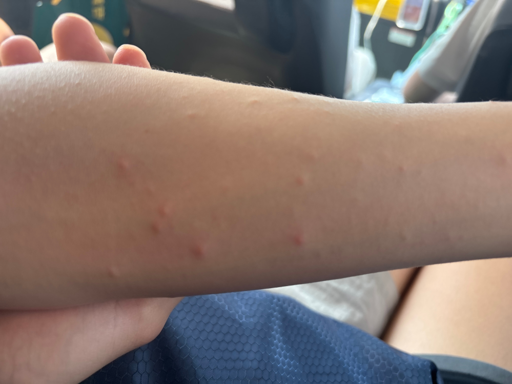 香港に行っているのですが3日目くらいから腕や足にぶつぶつができました何かわかる人いますか？
