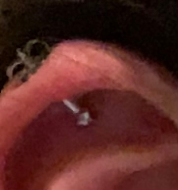 軟骨を開けたのですが、キャッチがこんな感じに耳の皮膚に浮いてるって言うよりくっついてしまってるのですが大丈夫ですかね…?