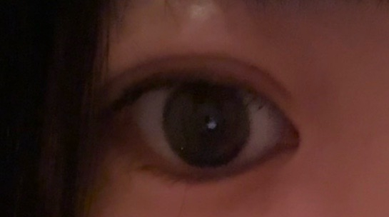 １ヶ月前に 埋没2点止めをしました。 ダウンタイムが終わって腫れが引いてきました。なので幅が狭くなったなって感じています。 これは糸が取れかけてるとかではないですか？