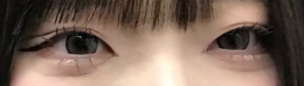 質問です。 写真の通り、私は元々激重一重の目を二重にしているのですがヒュン現象まではいかなくとも毎回、目頭側のまぶたの肉？脂肪？のせいで目がぱっちり開きません。そのせいで白目があまり見えなかったり黒目の部分にも上まぶたがかなり重なっていて目が綺麗に見えないのが悩みです。左はまだマシなのですが右が特に酷いような気がします。そのせいでまつ毛も上手く上がらず、いつも上にくるんとなるのではなく斜め45度くらいにしかなりません。写真を撮っても可愛くないですし盛れなくて悩んでいます。この場合、美容整形などは何をするのが正解なのでしょうか？目頭切開や埋没など視野に入れています。整形の経験がなく知識が乏しいので、有識者の方ぜひ教えて頂きたいです。