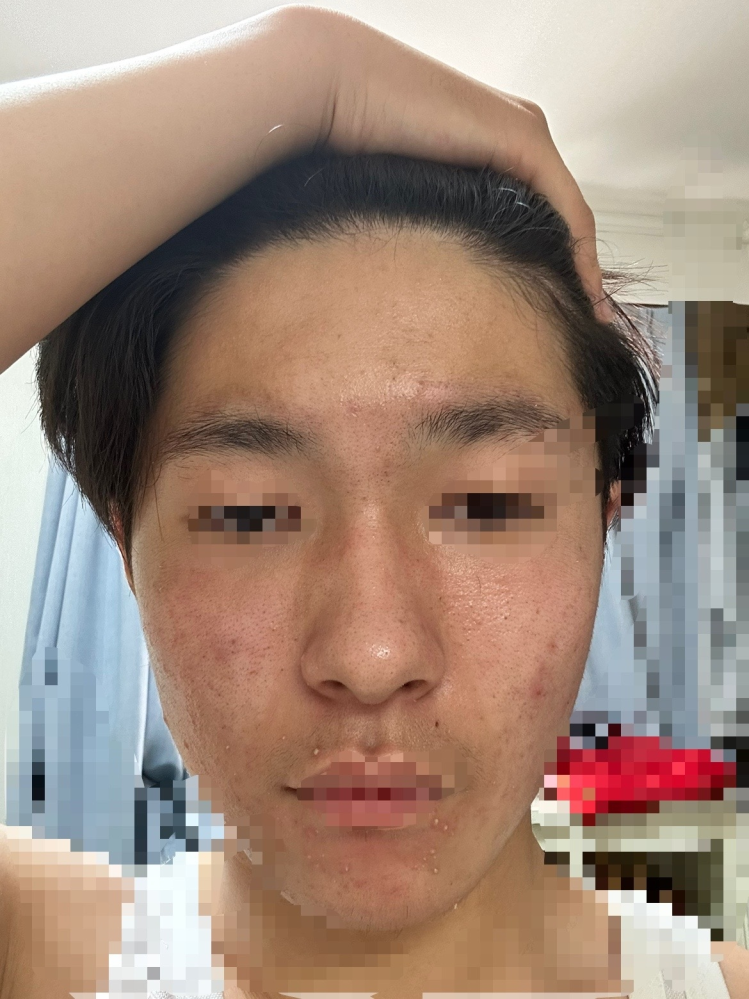 ニッキーズスキンクリア　Nikki's Skin Clear 通常用 ニッキーズスキンクリア Nikki's Skin Clear 通常使用 (シミ