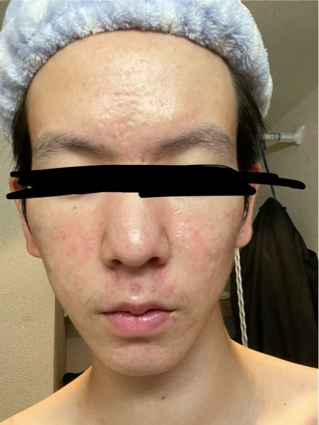 ニッキースキンクリアを買おうと思ってるんですが、現在使ってる人効果