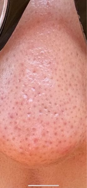 ニッキースキンクリアを買おうと思ってるんですが、現在使ってる人効果