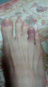 足の薬指をぶつけてしまいました 今朝 足の薬指を掃除機に Yahoo 知恵袋