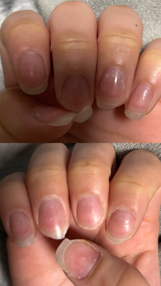両手の爪がほぼ全部折れたのですがネイルサロンで亀裂補強と欠けてる