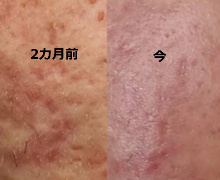 ニッキーズスキンクリアNikki'sSkinClearを購入し今日から - Yahoo