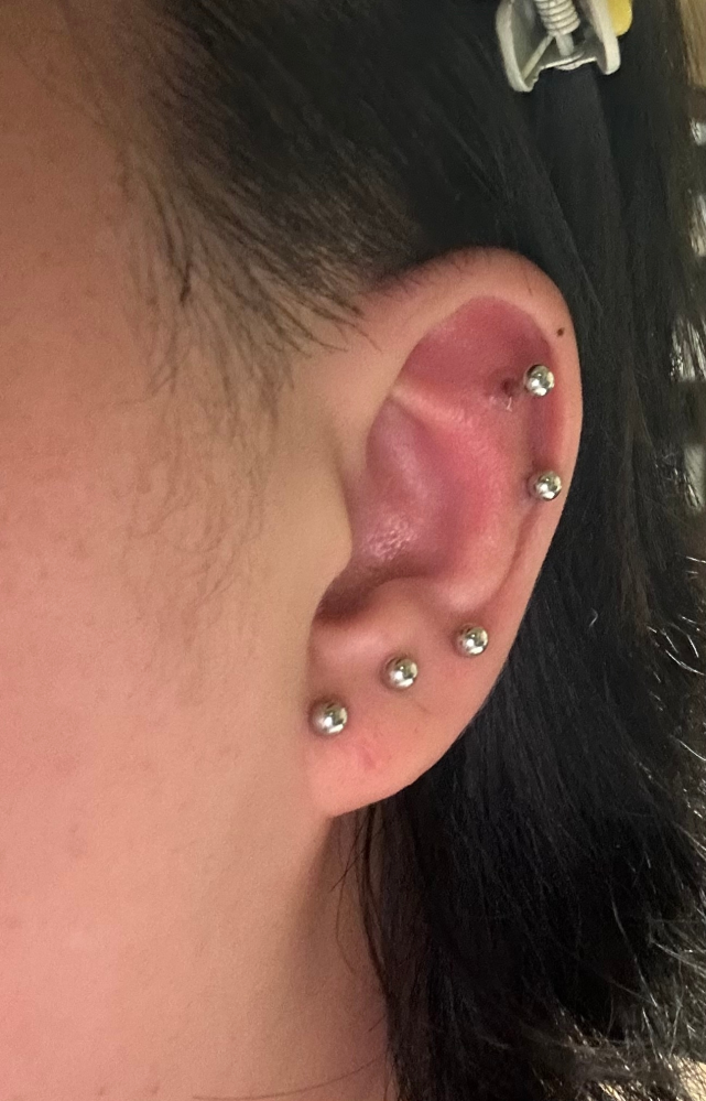 ピアスホールについて質問です。ピアスを開けて約1年半です。軟 