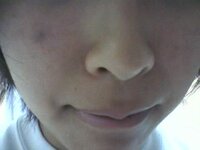 中2女子です 今日の朝おきてみたら ほっぺになんか黒い アザみたいなニ Yahoo 知恵袋