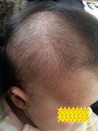 ２ヶ月の息子の頭皮がむけています 乾燥でしょうか 今は保湿に Yahoo 知恵袋