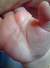 ７ヶ月の赤ちゃんの手のひらと指の間に 少し前から赤みと 細かい水膨 Yahoo 知恵袋
