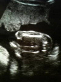 妊娠22週目です エコー写真で性別判断お願いします Yahoo 知恵袋